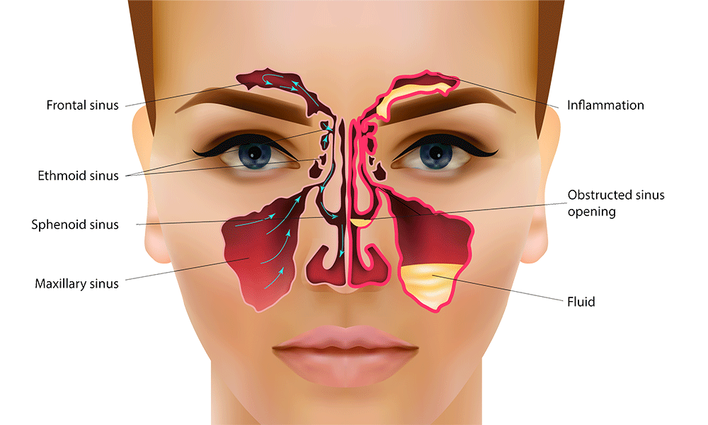 Illustration of chronic sinusitis